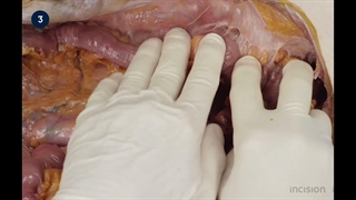 53 Open Sigmoidectomy - Non-neoplastic